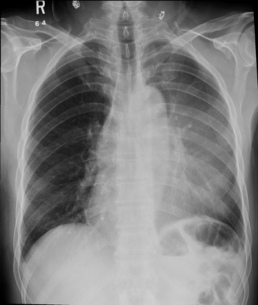 Left upper lobe collapse | Radiology Case | Radiopaedia.org