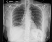 Lymphocytic interstitial pneumonitis | Radiology Reference Article ...