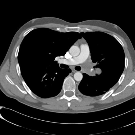 Primary pulmonary artery leiomyosarcoma | Radiology Reference Article ...