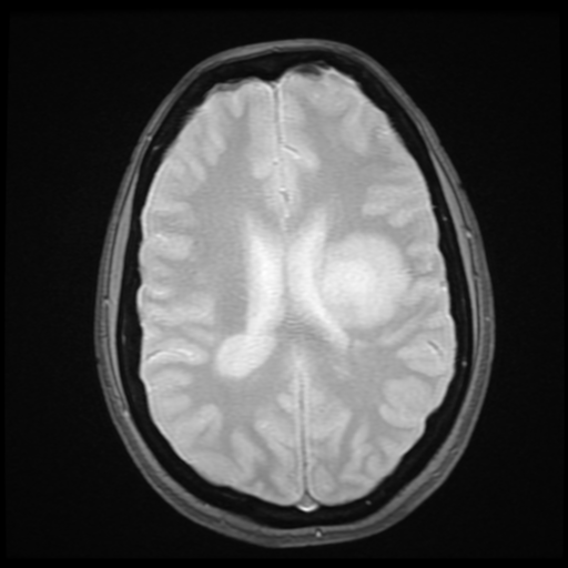 Acute Disseminated Encephalomyelitis (ADEM) | Image | Radiopaedia.org