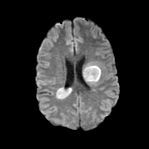 Acute Disseminated Encephalomyelitis (ADEM) | Image | Radiopaedia.org