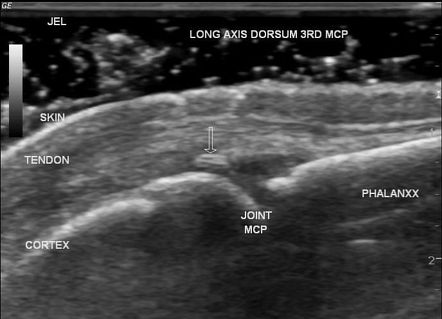 Foreign body-induced metacarpophalangeal joint synovitis | Radiology ...