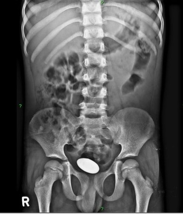 Bladder calculus | Radiology Case | Radiopaedia.org