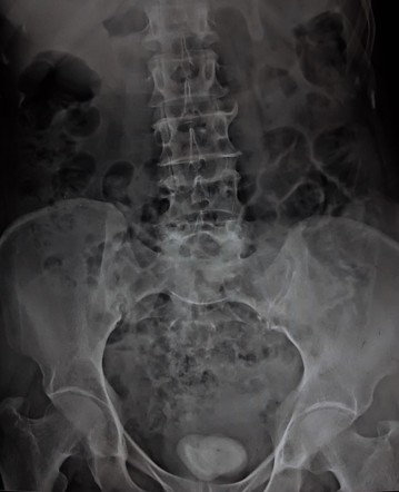 Bladder Calculus | Radiology Case | Radiopaedia.org