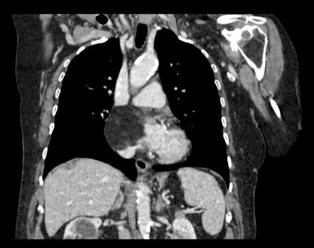 Cardiac lipoma | radiology reference article | radiopaedia.org