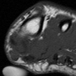 Schwannoma of the foot | Image | Radiopaedia.org