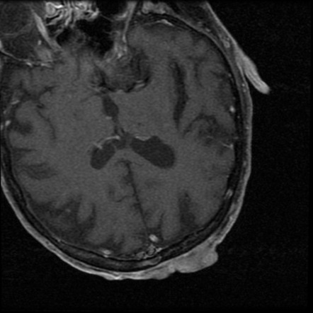 Sarcoma of the scalp | Image | Radiopaedia.org