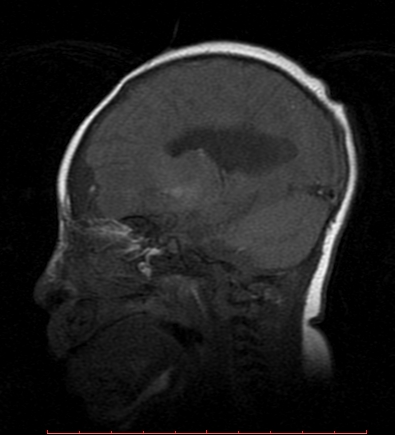 Semilobar holoprosencephaly | Image | Radiopaedia.org