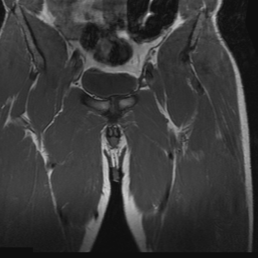 Proximal rectus femoris avulsion injury | Image | Radiopaedia.org