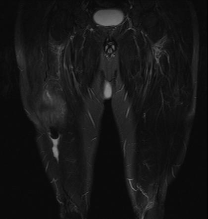 Distal rectus femoris tendon tear | Radiology Case | Radiopaedia.org