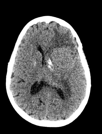 Multiple chordoid meningiomas - post-radiotherapy | Image | Radiopaedia.org