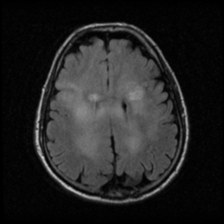 Glioblastoma IDH wild-type (multifocal) | Radiology Case | Radiopaedia.org