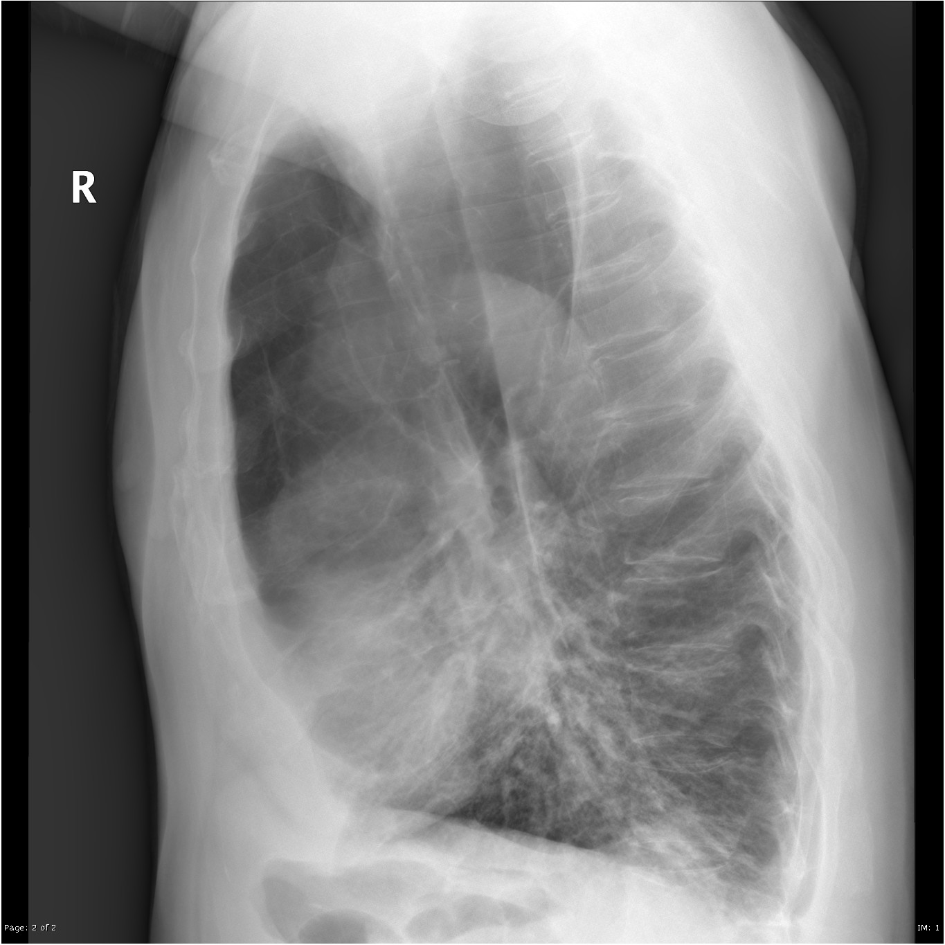 Bullous emphysema | Image | Radiopaedia.org