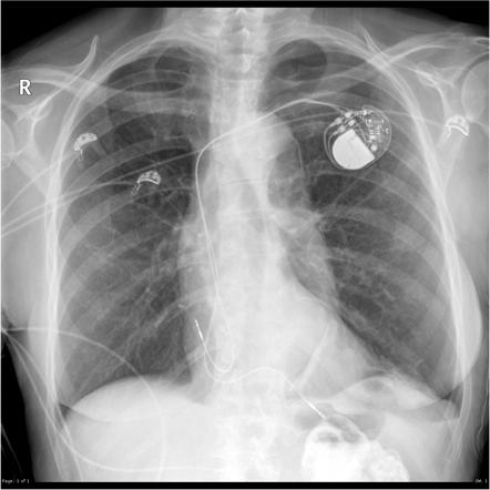 Playlist 'Chest x-rays (iOS pack)' by Assoc Prof Frank Gaillard