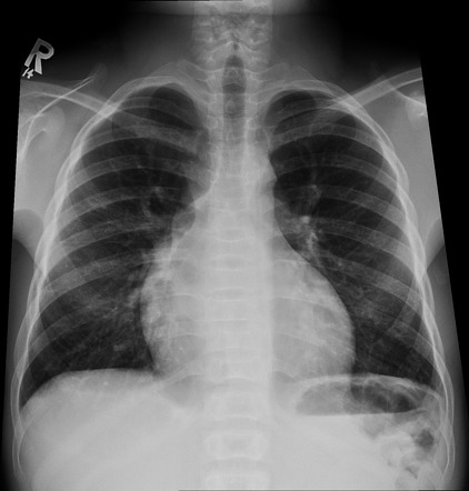 Persistent left superior vena cava | Radiology Case | Radiopaedia.org