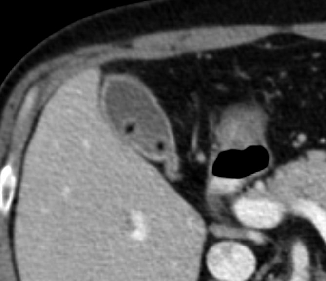 Pigment gallstones | Image | Radiopaedia.org