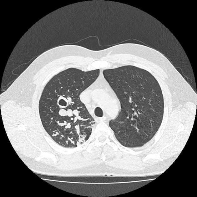 Allergic Bronchopulmonary Aspergillosis Radiology Case Radiopaedia Org