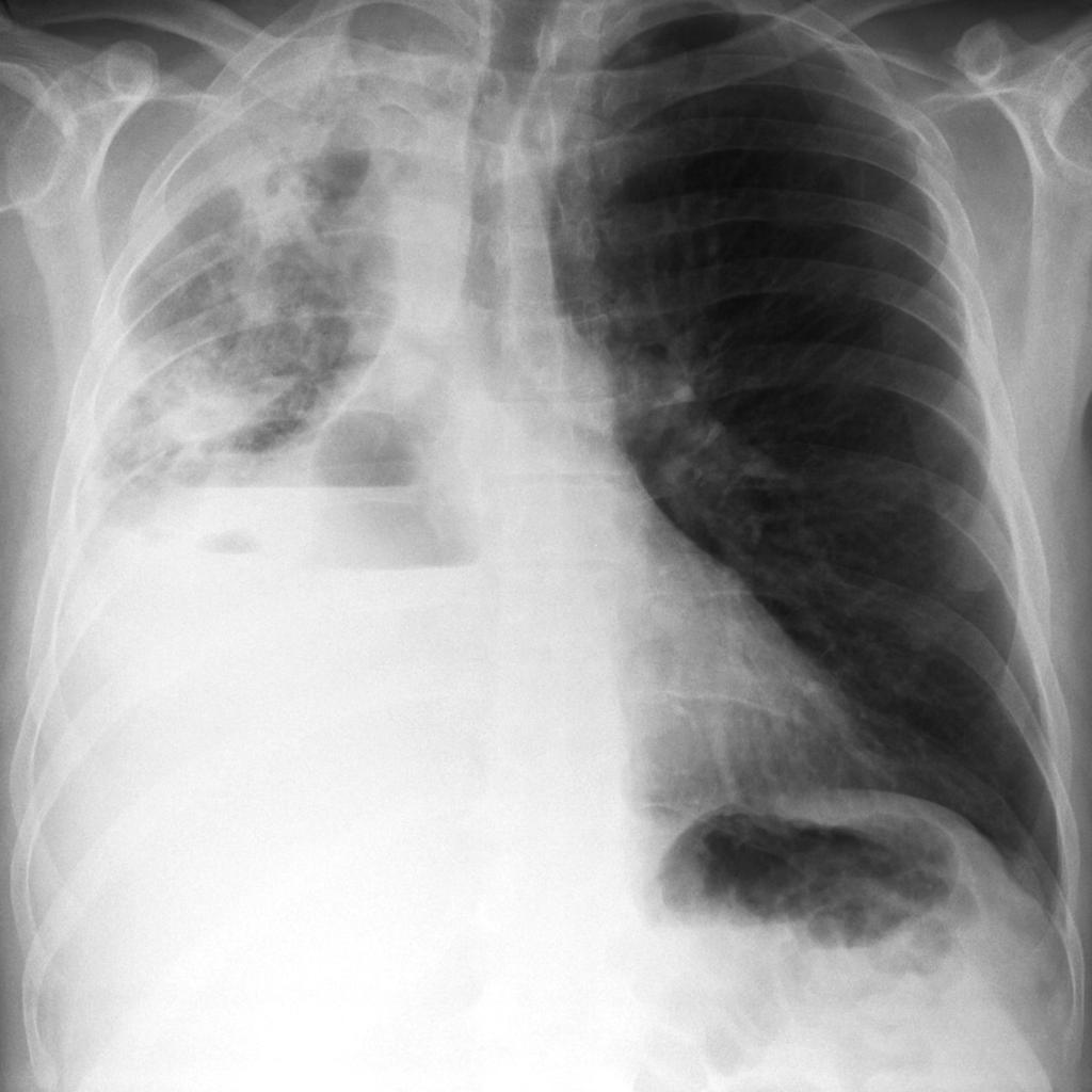 Pleural Empyema Radiology Case Radiopaedia Org