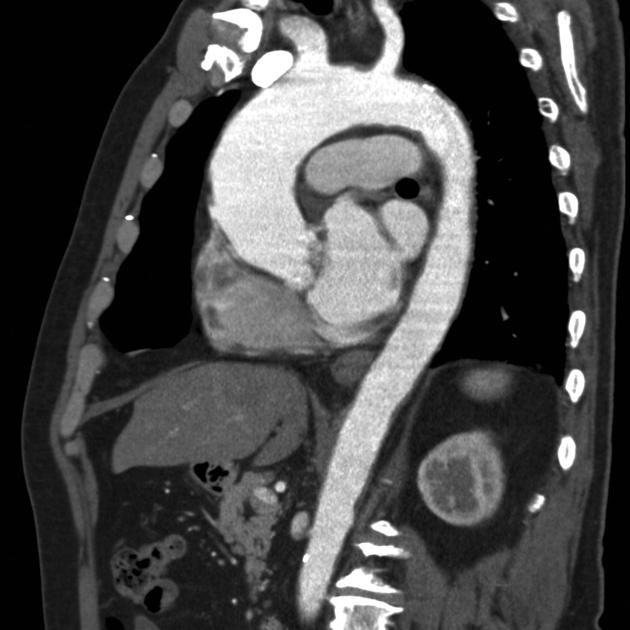 aortic stenosis x ray