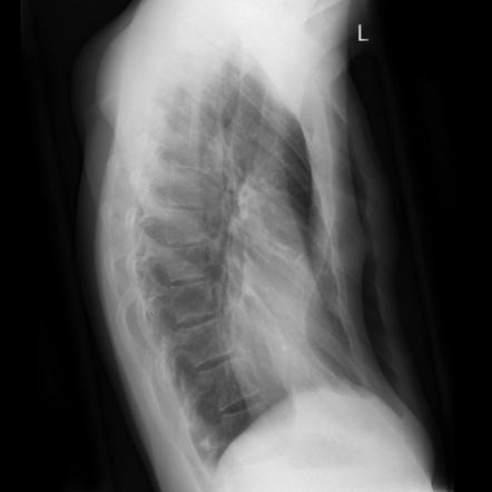 Pectus excavatum | Radiology Case | Radiopaedia.org