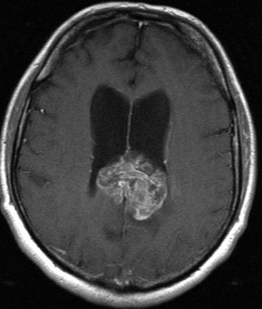 Butterfly glioma | Radiology Reference Article | Radiopaedia.org