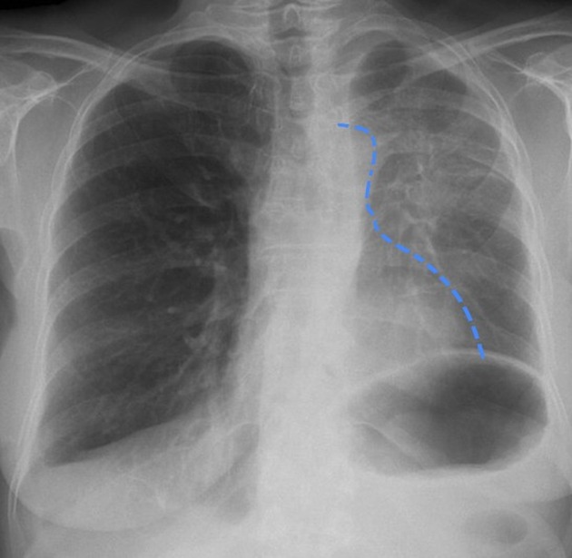 Left upper lobe collapse | Radiology Reference Article | Radiopaedia.org