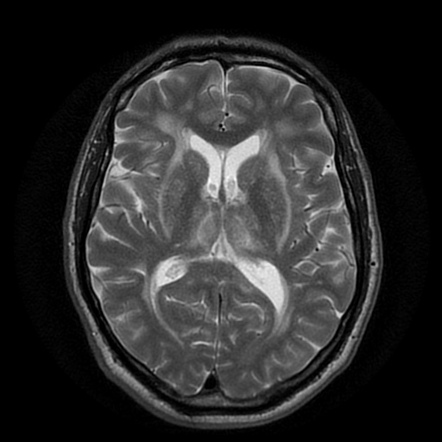 HIV encephalopathy | Radiology Case | Radiopaedia.org