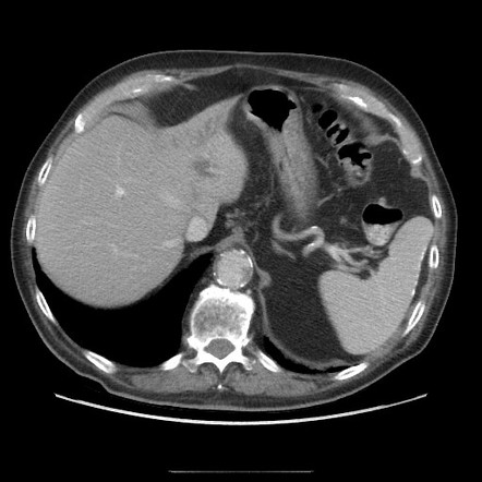 Left lobe atrophy due to biliary obstruction | Radiology Case ...