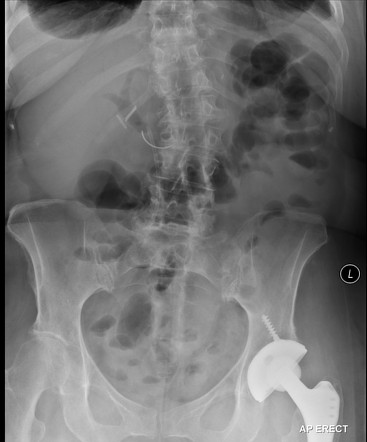 Retained Suture Needle Radiology Case Radiopaedia Org