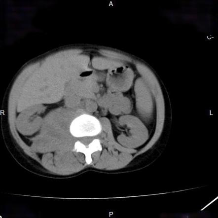 Rhabdomyosarcoma | Radiology Reference Article | Radiopaedia.org