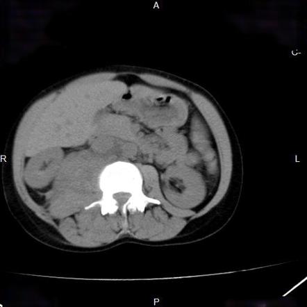 Tumors of muscular origin | Radiology Reference Article | Radiopaedia.org