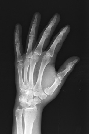 Thumb metacarpal fracture | Image | Radiopaedia.org