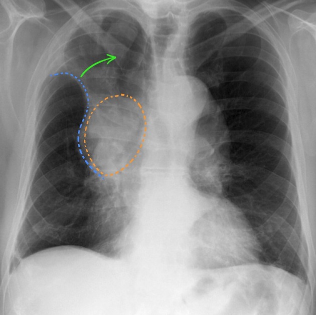 Golden S-sign (lung lobe collapse), Radiology Reference Article