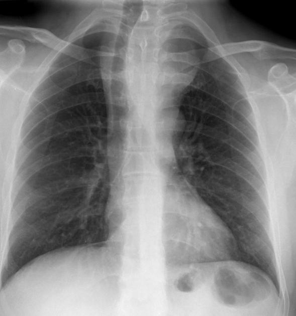 Substernal goiter | Radiology Reference Article | Radiopaedia.org