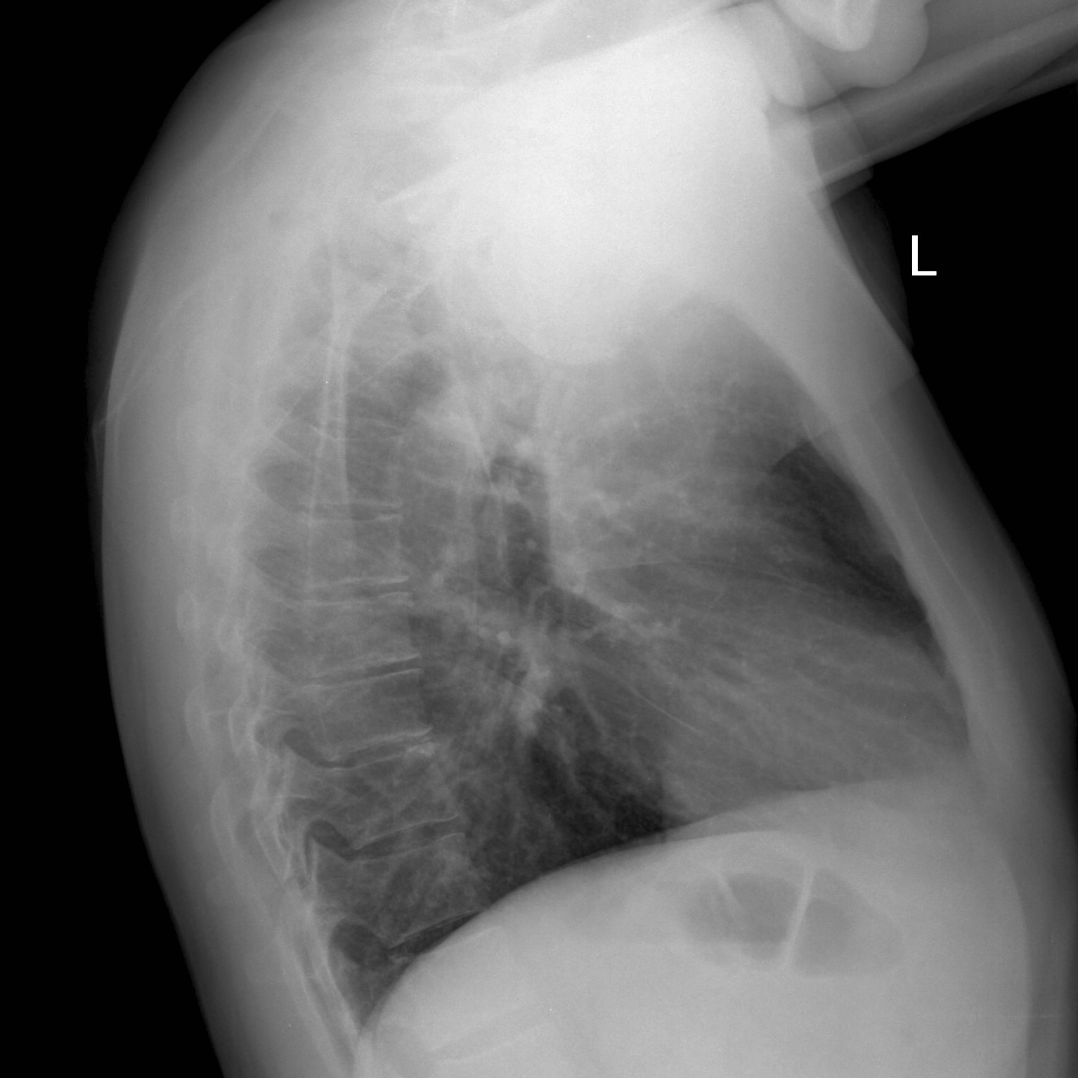 Retrosternal goiter | Image | Radiopaedia.org