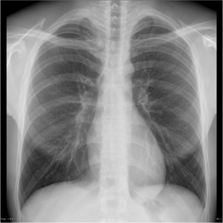 Coarctation of the aorta | Radiology Reference Article | Radiopaedia.org