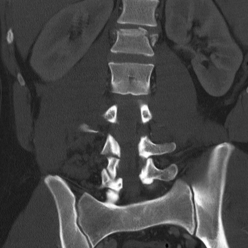 Chance fracture | Image | Radiopaedia.org