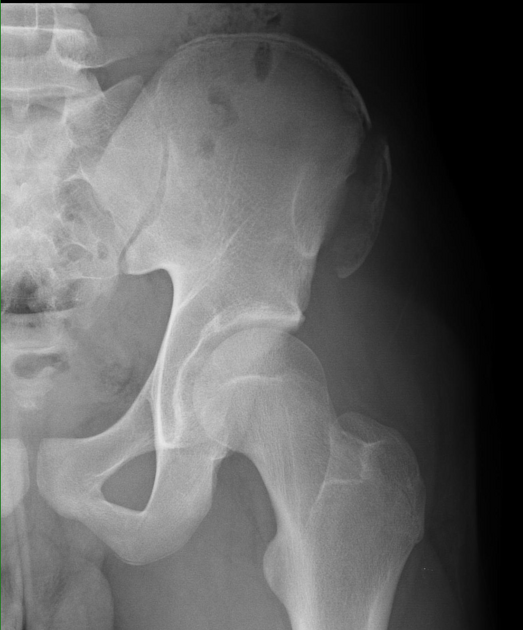 Anterior superior iliac spine avulsion, Radiology Case