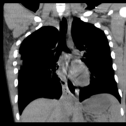 Hemothorax due to rib fracture | Image | Radiopaedia.org