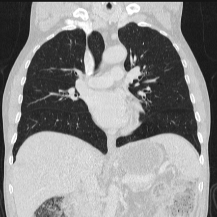 Azygos lobe | Image | Radiopaedia.org