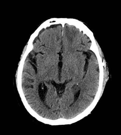 Subacute hemorrhagic contusions | Image | Radiopaedia.org