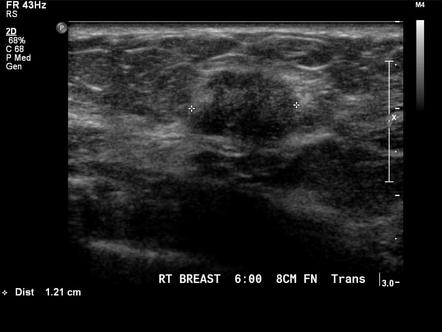 Tubulolobular carcinoma of the breast | Radiology Reference Article ...