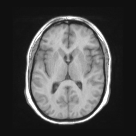 Viral meningitis and papilledema | Image | Radiopaedia.org