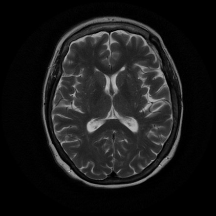 Neurofibromatosis type 2 - with multiple meningiomas | Image ...