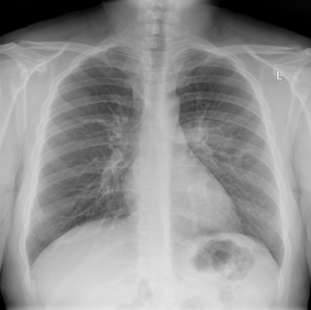 Apical segment left lower lobe pneumonia | Radiology Case | Radiopaedia.org