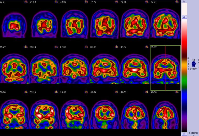 Biparietal parenchymal volume loss | Image | Radiopaedia.org