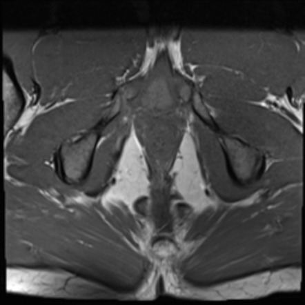 Normal MRI pelvis (fistula protocol) | Image | Radiopaedia.org