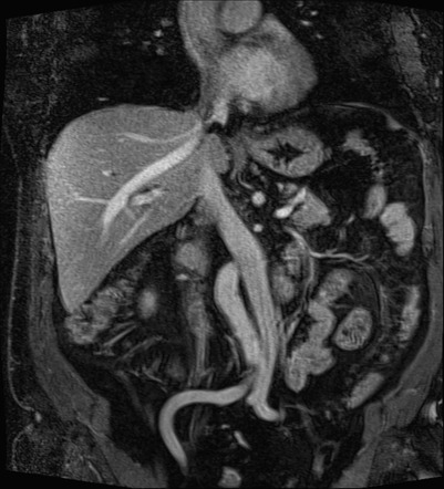 Annular pancreas | Image | Radiopaedia.org