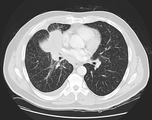 Lung Cancer Adenocarcinoma Image 2681