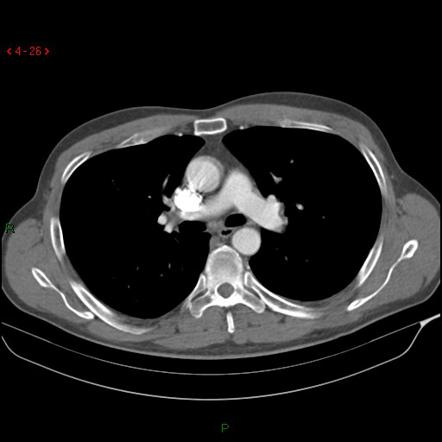 Pulmonary artery embolism | Radiology Case | Radiopaedia.org